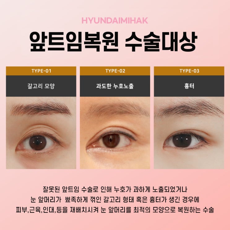 Restoring a Natural Eye Shape with Epicanthoplasty Revision