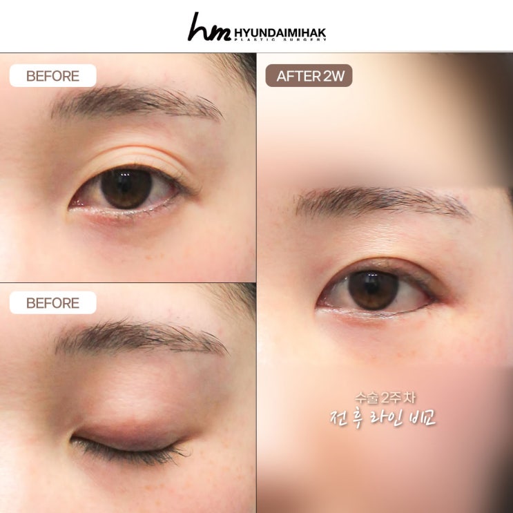 Natural Adhesion Double Eyelid Surgery: Become More Beautiful Without Incisions at Hyundai Aesthetic Surgery