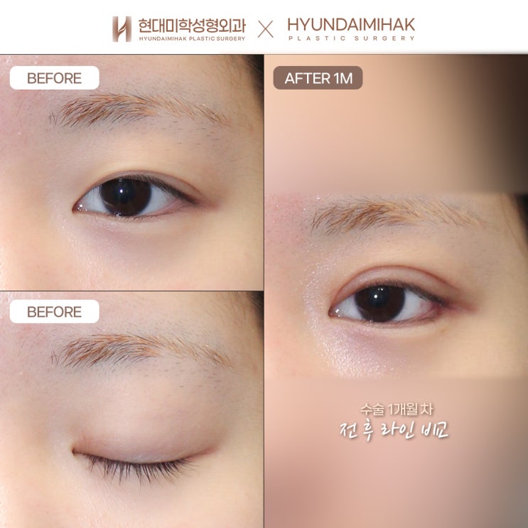 Non-incision double eyelid surgery for defined eyes without visible scarring