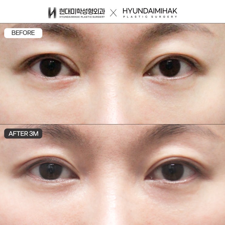 For correcting sagging double eyelids and droopy-looking eyes