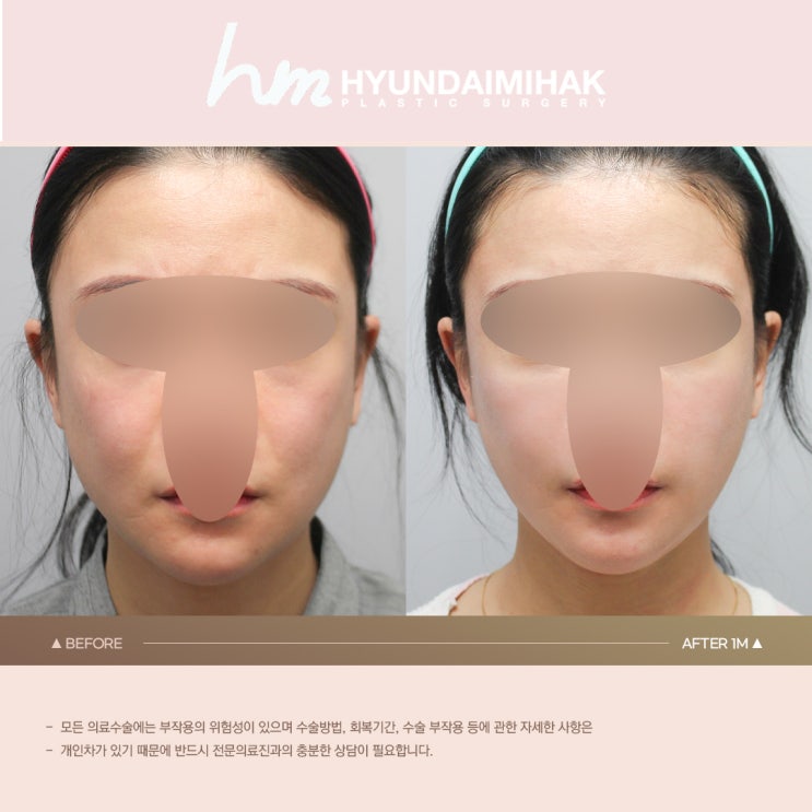 Hyundai Aesthetic Surgery Facial Liposuction Real Q&A│A Must-Read If You’re Curious About Facial Liposuction