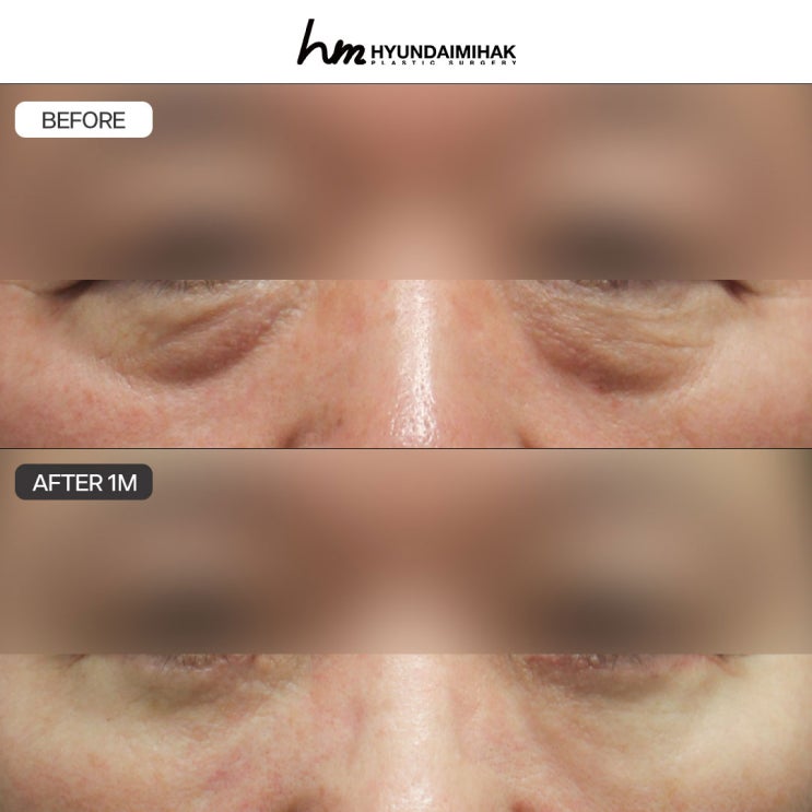 Middle-Aged Lower Blepharoplasty: The Secret to Naturally Younger-Looking Eyes