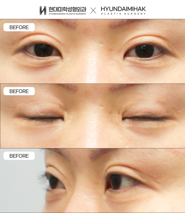 Double-Eyelid Line Lowering Surgery, Tailored to the Amount of Available Skin