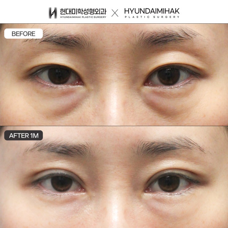 Resolve drooping eyelids at a clinic known for upper blepharoplasty, with improved vision as well
