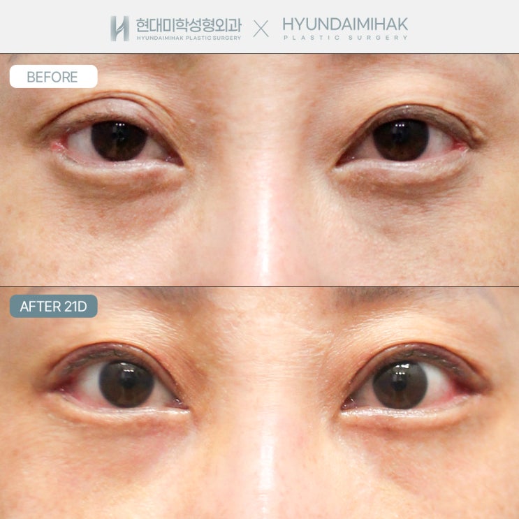 What Is the Ideal Thickness When Lowering the Double-Eyelid Line?