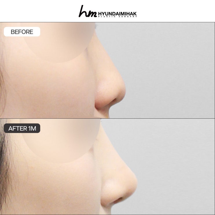 Key Points to Know Before and After Nose Surgery