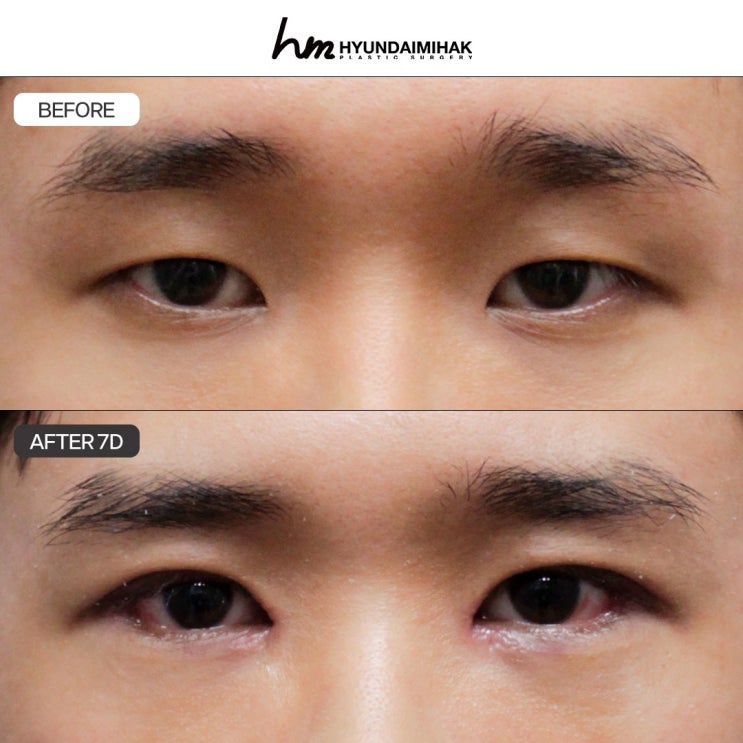 Male Eye Surgery Clinic: Natural-Looking Results Are Key