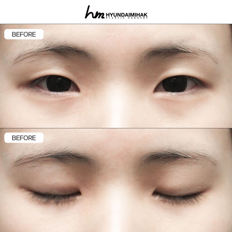 Incisional Double Eyelid Surgery: Design-Based Surgery That Changes the Essence of the Eyes | Complete Guide to Surgical Methods, Satisfaction, and Recovery