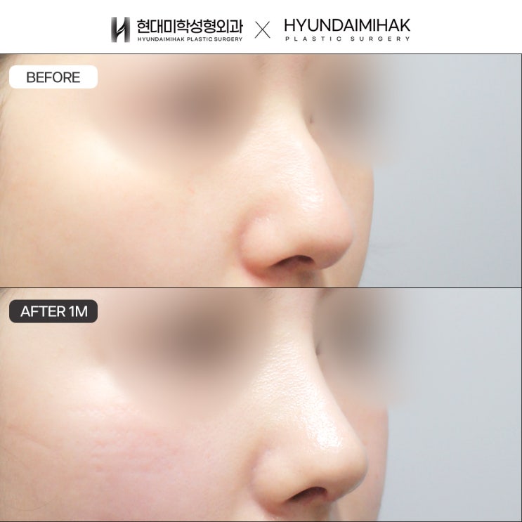 Female hump nose correction: a delicate design that considers facial balance and harmony with function