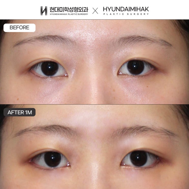 Posterior Canthoplasty and Lower Canthoplasty: Effective Methods and Precautions for Improving the Eye Shape