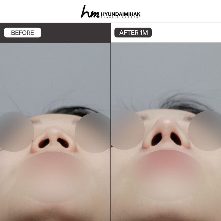 Upturned Nose Correction: A Key Solution for Changing Your Impression