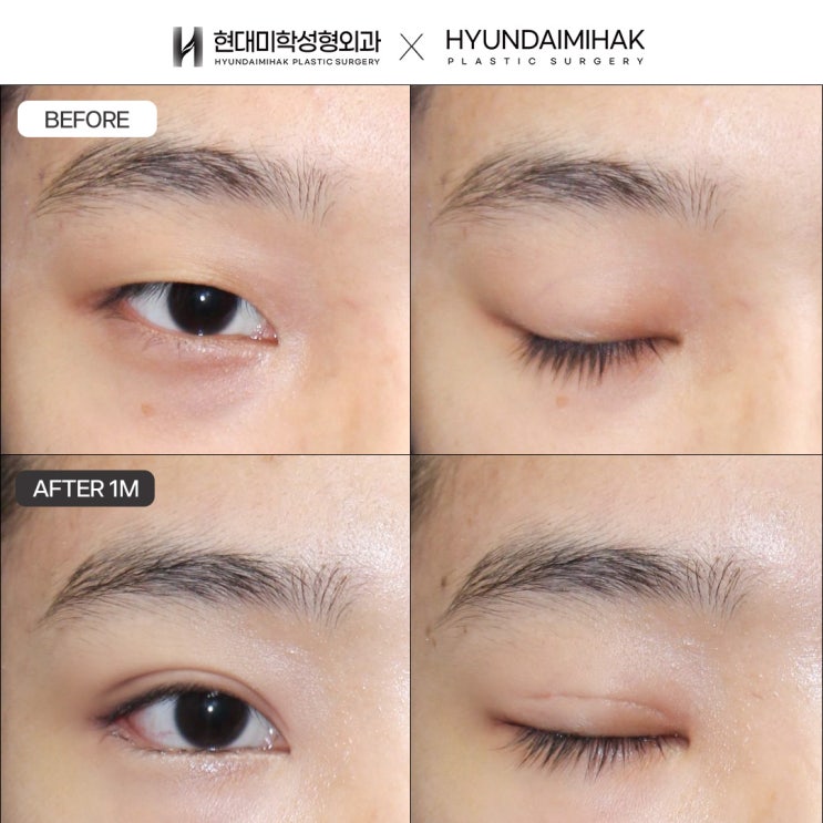 Natural adhesion double eyelid surgery: the optimal choice for a natural and stable eye shape