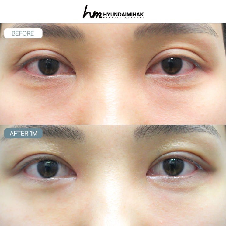 A Collection of Eye Revision Surgery Reviews: Success Points Explained by Hyundai Aesthetic Surgery