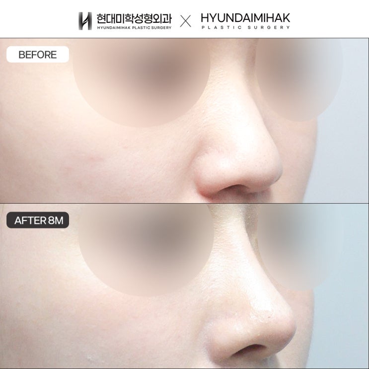 What to Consider When Looking for a Good Rhinoplasty Clinic in Seoul