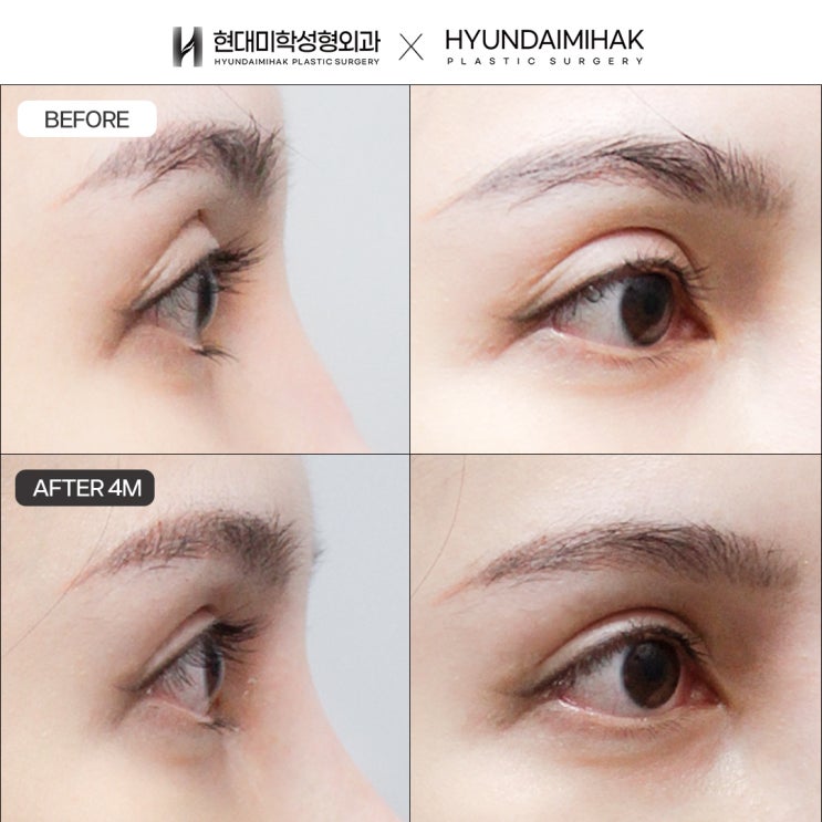 The Best Solution for Revision Surgery for Sausage-Looking Double Eyelids Without Failure
