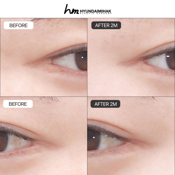 Lateral Canthoplasty Restoration: A Customized Solution for Eyes That Feel Reborn