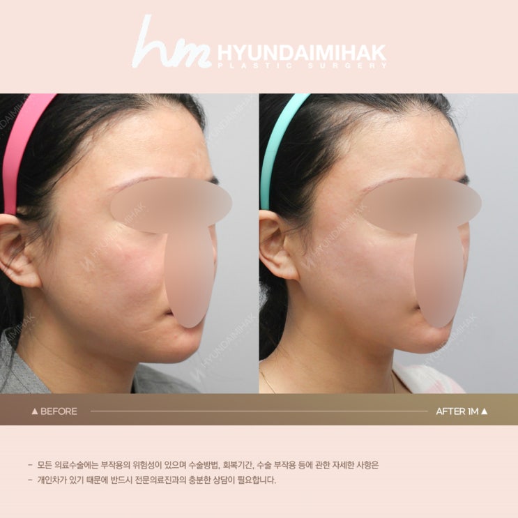 Recommended Contour Injections: If You Want to Refine Facial Fullness and Find Your V-Line