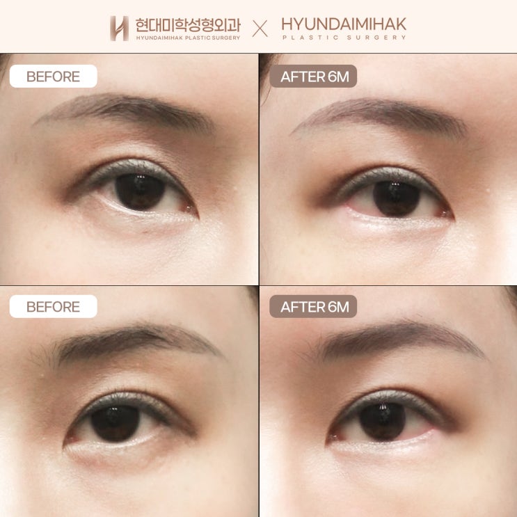 Comparing reviews of lateral canthoplasty and lower canthoplasty: designing beautiful eyes