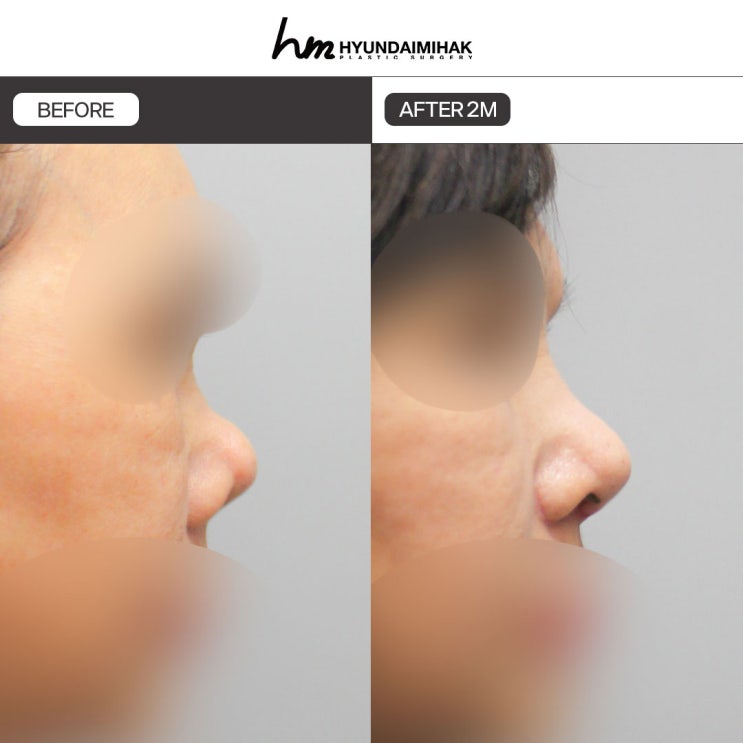 Why Contracted Nose Surgery Is Needed and How to Prepare for It