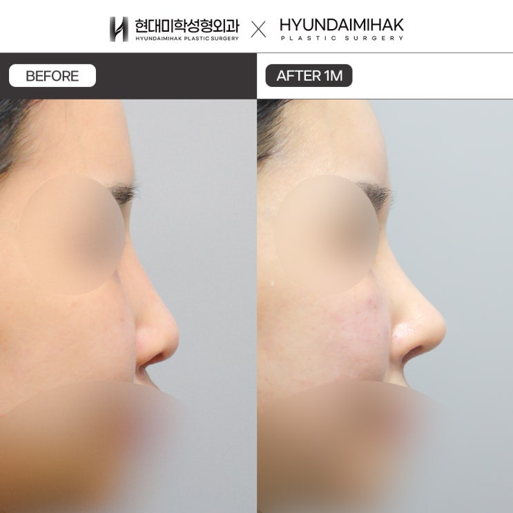 Understanding the Advantages and Features of Autologous Rib Cartilage Rhinoplasty
