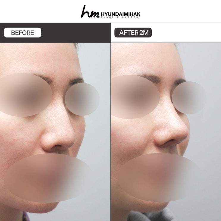 Low Nose Surgery Can Make Things Worse If Done Incorrectly