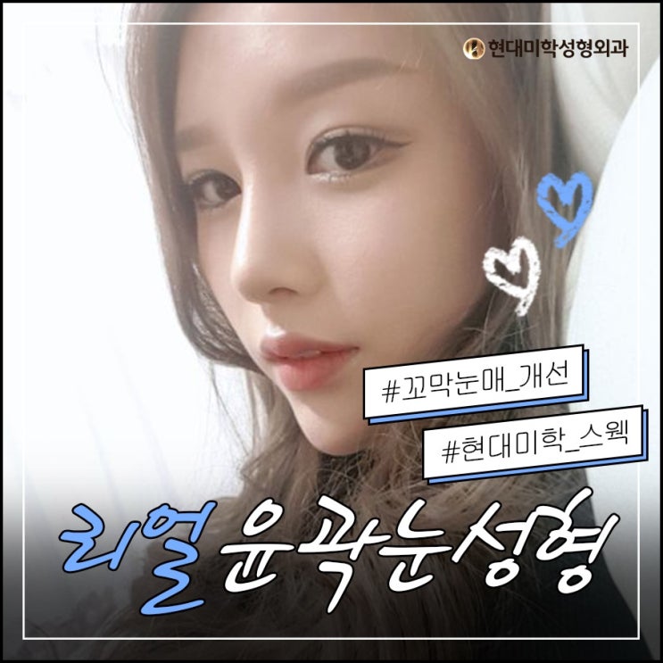 Ptosis Correction for a Brighter, Less Sleepy-Looking Gaze