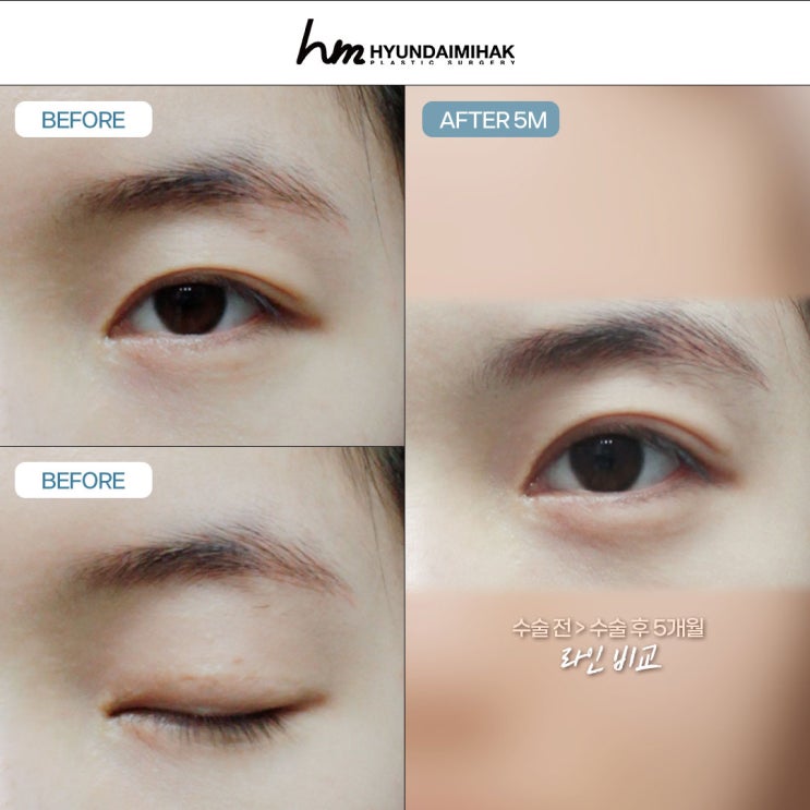 Eyelid Ptosis Correction Surgery: The Key to Creating a Natural, Clear Impression