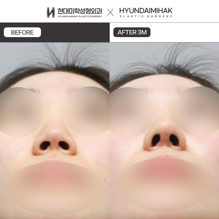 Non-incisional alar reduction for a nose that looks blunt