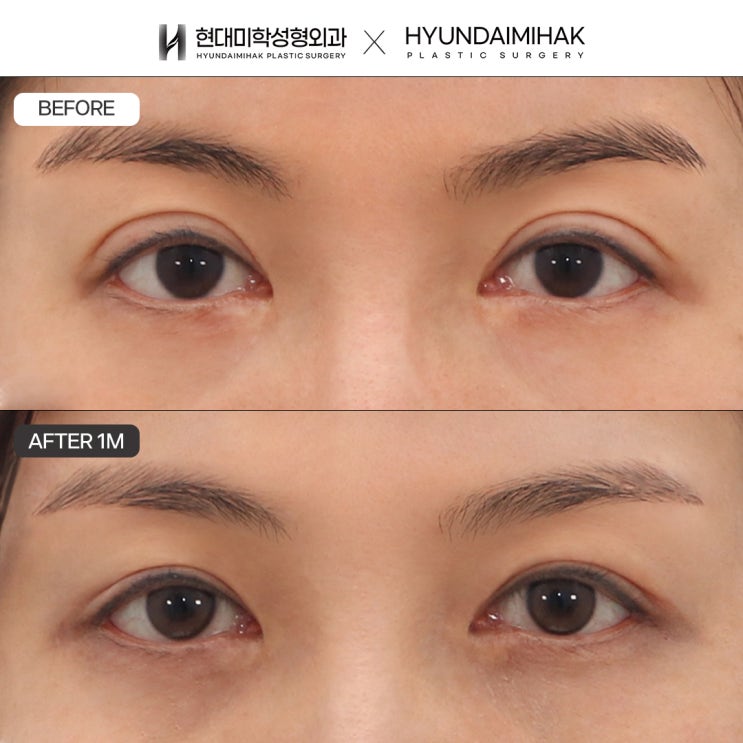 Let’s naturally restore a failed double eyelid with line-lowering surgery