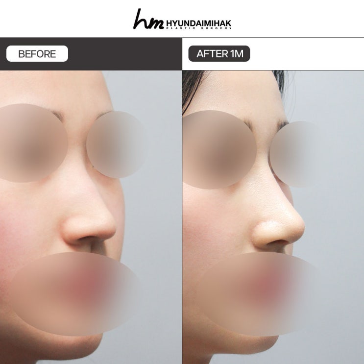 Hump Nose Surgery Price: Cheaper Doesn’t Mean Better