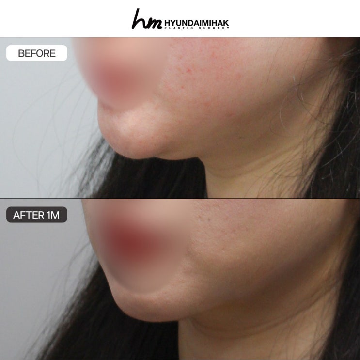 Remarkable before-and-after changes with thread lifting, led by Hyundai Aesthetic Surgery