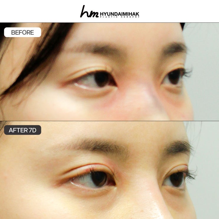 Why Hyundai Aesthetic Surgery Is the Right Choice for Eye Surgery in Gangnam