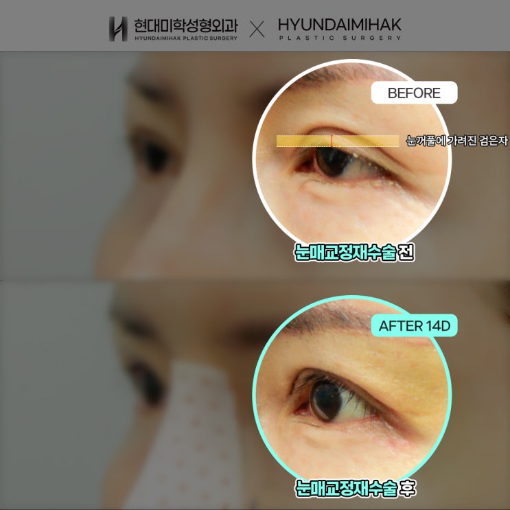 Gangnam Eye Revision Surgery: Things to Check Before Proceeding