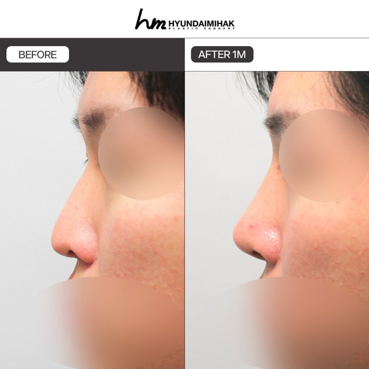 The Secret Behind the Changed Impression in Male Rhinoplasty Before and After