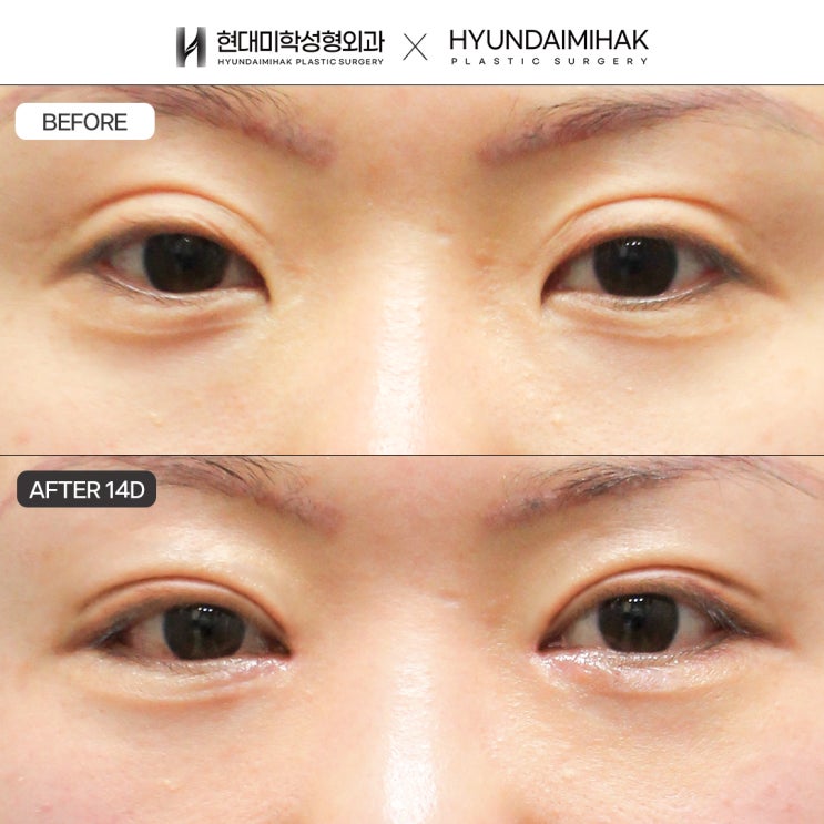 Lowering a Double-Eyelid Line to Improve an Artificial-Looking Eye Shape