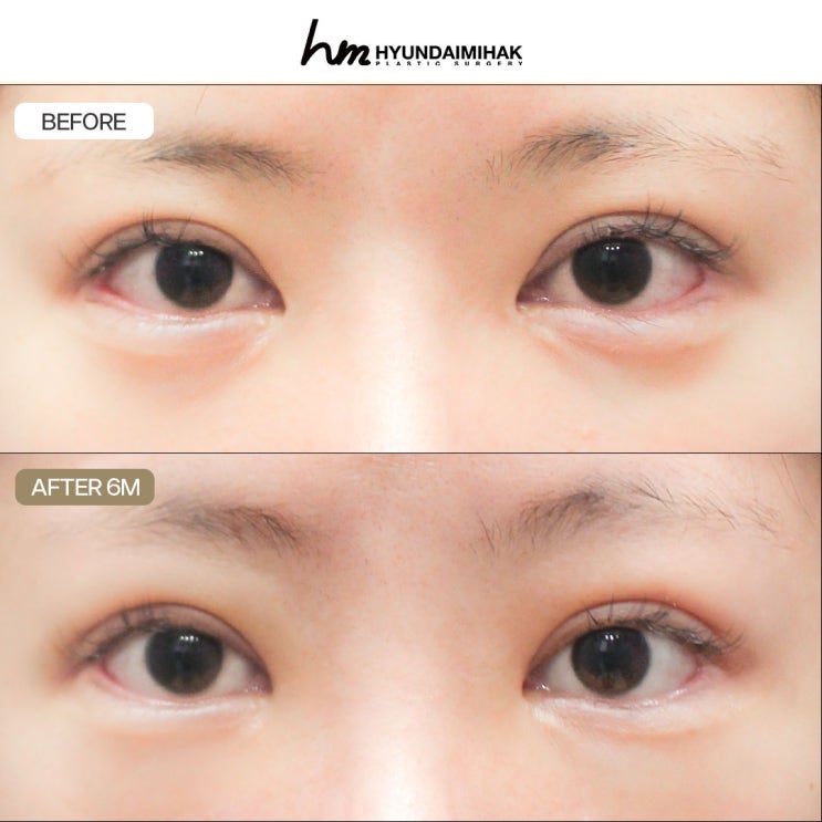 Epicanthoplasty Reconstruction: How to Reverse a Botched Epicanthoplasty