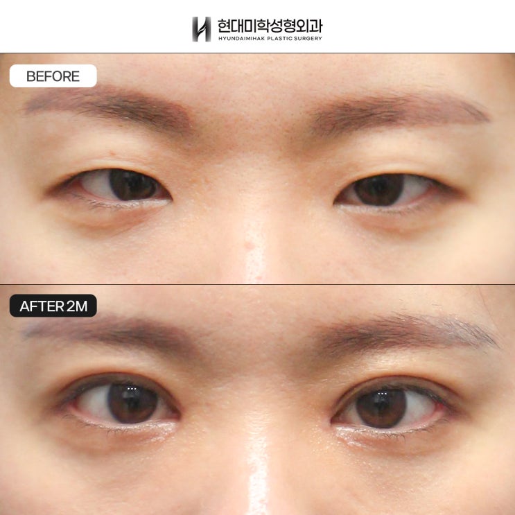 Incisional Double Eyelid Surgery Review: Correcting the Eye Shape at the Same Time
