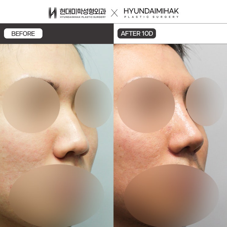 Reviewing various cases at a male rhinoplasty clinic