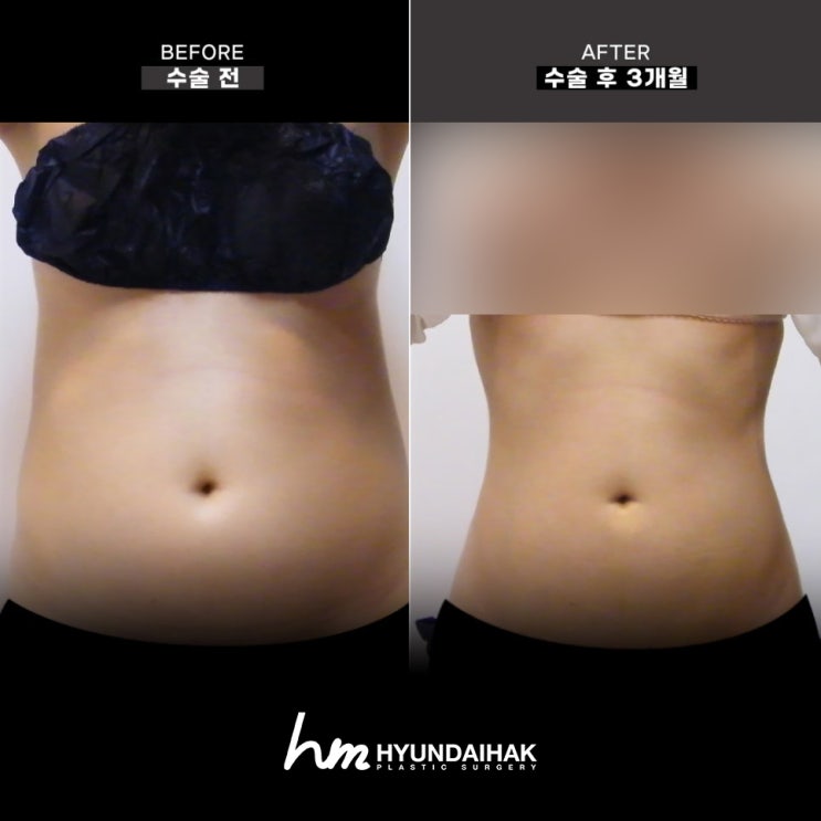 Abdominoplasty pricing at a Sinsa Station plastic surgery clinic that is reasonable and proven by results