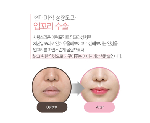 Mouth Corner Lift Review: Finding the Bright Smile That Was Hidden Within