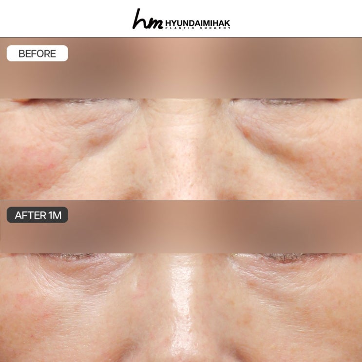 Middle-Aged Eye Surgery: The Secret to Restoring a Youthful Look