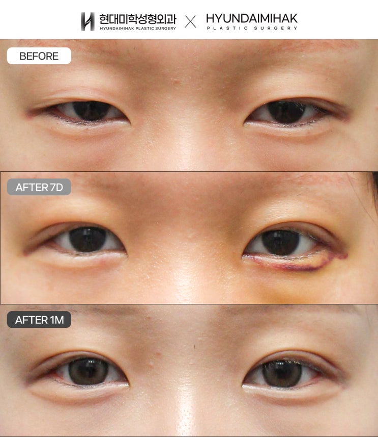 Types of Double-Eyelid Lines for Various Eye Shapes