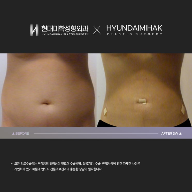 Upper and lower abdominal liposuction, considering the waist and pelvic lines