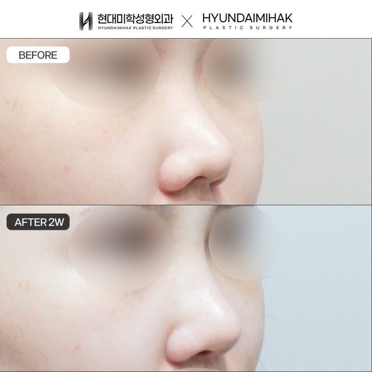 Nose reduction surgery: a choice that can boost your confidence