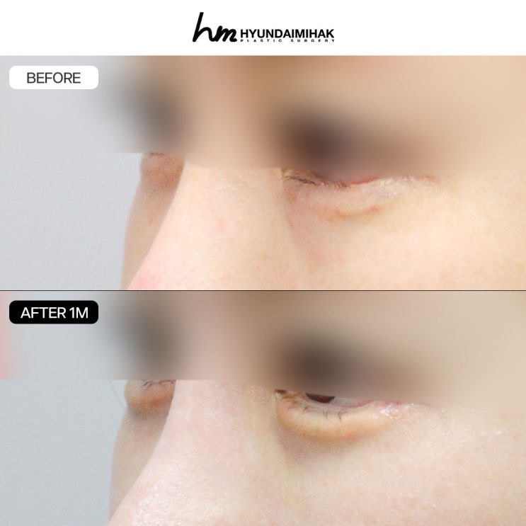 A Checklist for Properly Understanding Under-Eye Fat Grafting Reviews