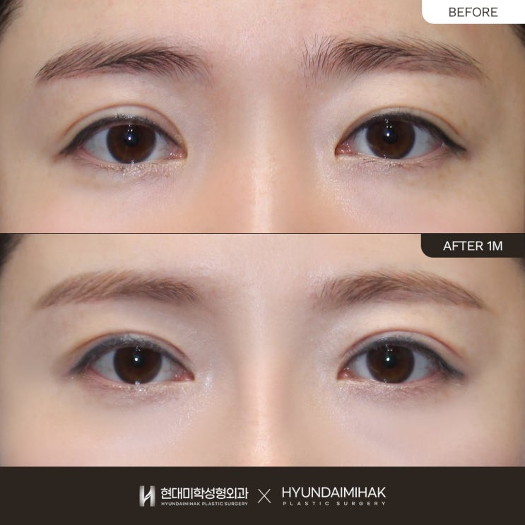 If you want to resolve your complex with double eyelid surgery for asymmetrical eyes
