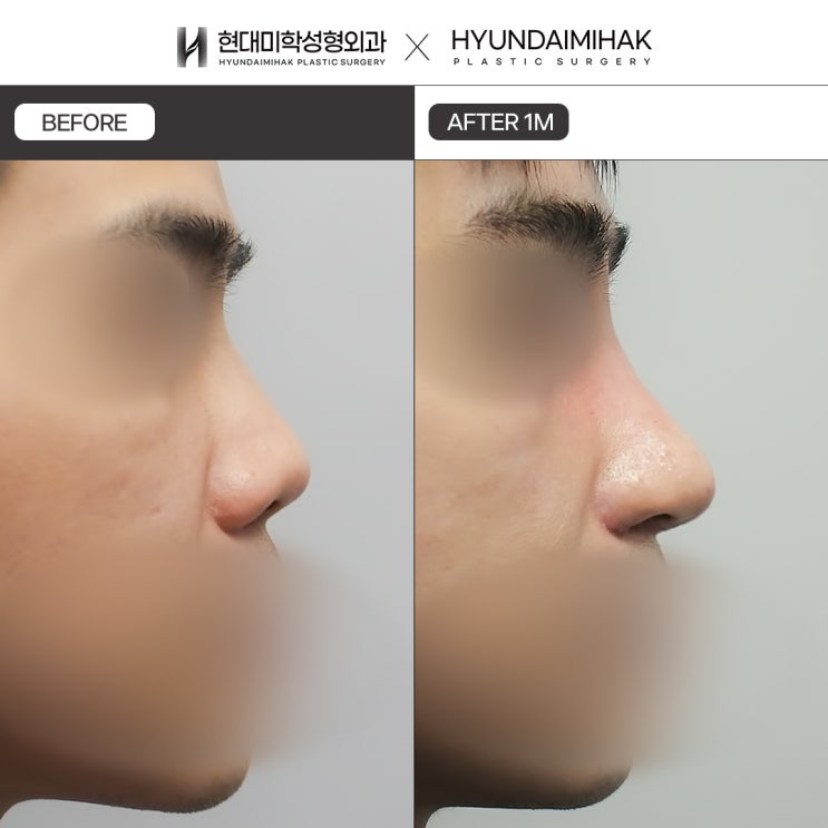 Male upturned nose surgery: a subtle difference in angle