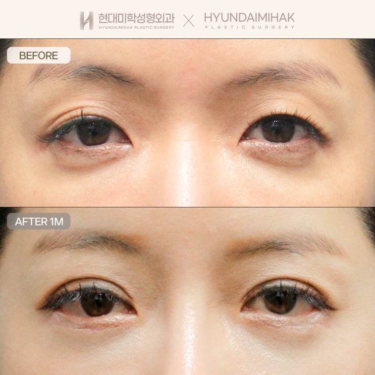 Double Eyelid Surgery with Ptosis Correction: A Smart Choice for Improving the Eye Shape