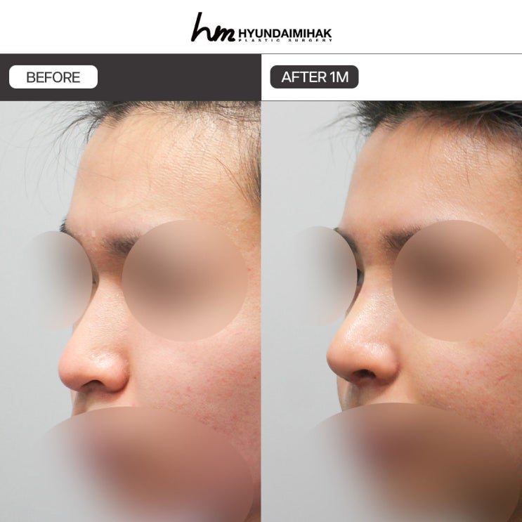How to Naturally Raise a Low Nose in Men