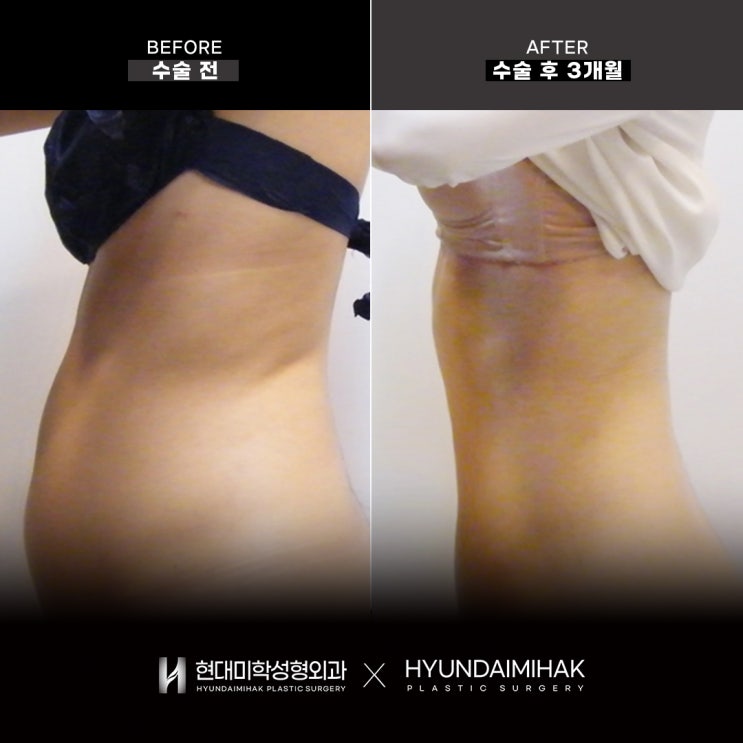 Price, effects, and side effects of Wegovy prescribed at Gangnam Wegovy clinics